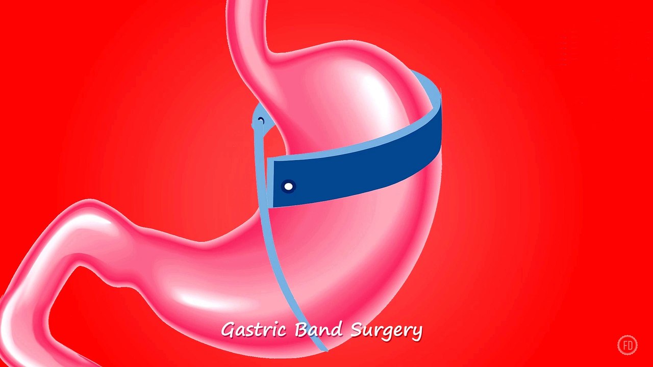 Gastric Band Surgery | Medical Education | HD Video | F1 Digitals