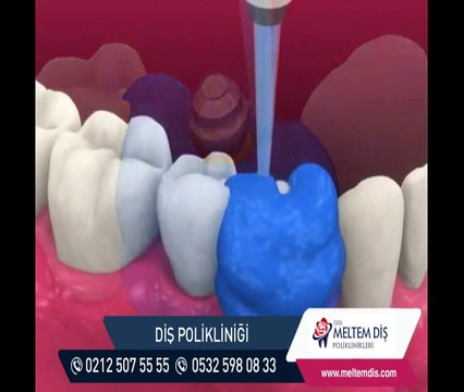 Diş İmplantı nasıl takılır? İmplant Fiyatları - İmplant Tedavisi