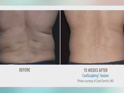 Precise Body offers a way to lose inches