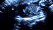 Sonogram Pregnancy 15 weeks - Embarazo 15 semanas