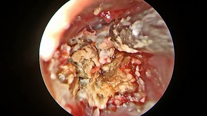 Stuck Earwax At Its Worst!