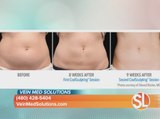 VeinMed Solutions offers Coolsculpting