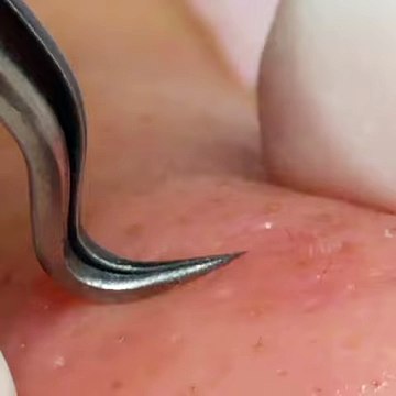 Mini#2-無痛清粉刺-台東心怡美顏館-林季儀老師