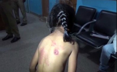 Bengaluru Girl Beaten With Leather Belt Allegedly For Not Doing Homework