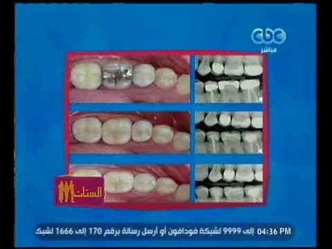 الستات مايعرفوش يكدبوا | الجديد في طب تجميل الأسنان مع استشاري طب الفم والأسنان