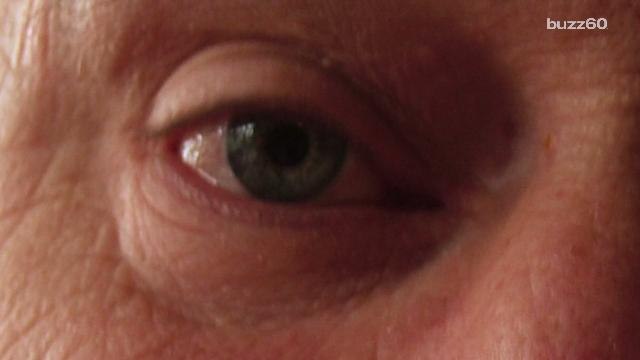 Why Do We Get Dark Circles and Bags Under Our Eyes?