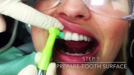 How We Do- Teeth Whitening Video