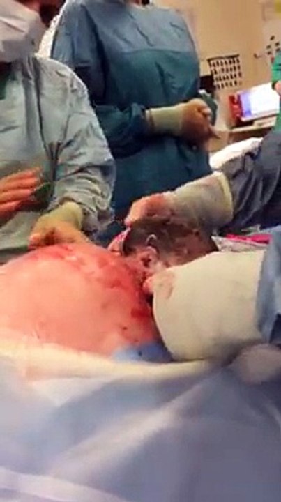 Les chirurgiens décident de laisser ce nouveaux-né sortir tout seul du ventre de sa mère pendant une césarienne