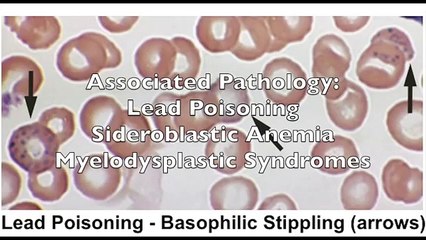 USMLE Highly Tested Topic: Few High-Yield Pathologic RBC Forms only
