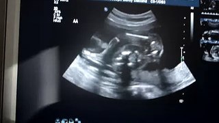 Twins-20 week ultrasound