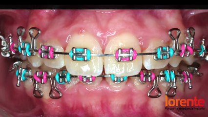 Lorente Ortodoncia - Caso Real 10