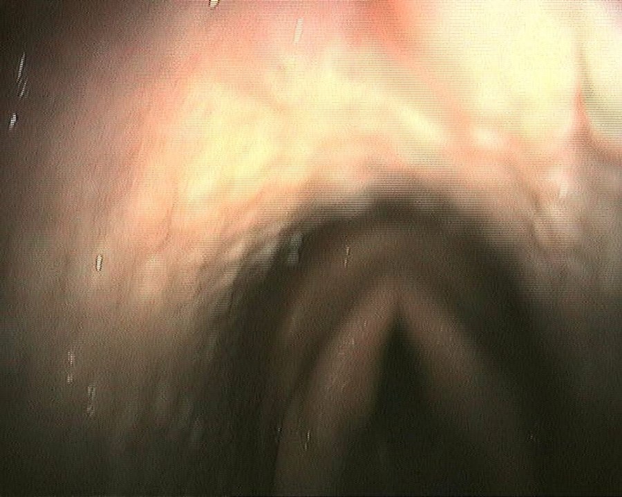 Phatyngite folliculaire Chez un cheval souffrant d'IAD