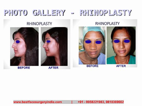 Nose Reshaping in Delhi - Rhinoplasty Surgery in Delhi