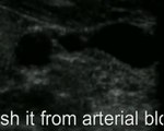 Ultrasound-Guided Internal Jugular Vein Cannulation