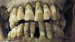 The dental warning signs starvation Victims Irish potato famine identified using TEETH