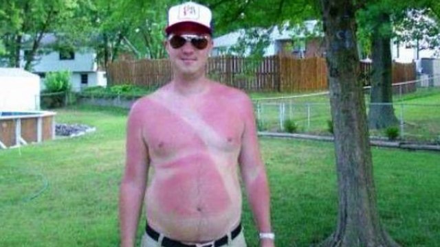 30 Komik Güneş Yanığı