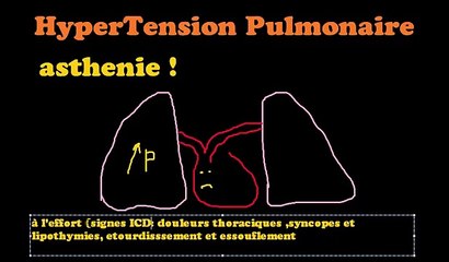 HyperTension Pulmonaire