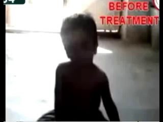 ضمور المخ