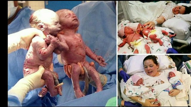 Meninas gêmeas nascem de mãos dadas em hospital e deixa medicos emocionados