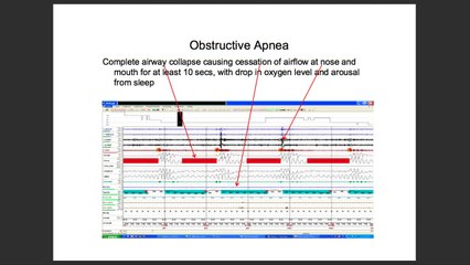 Obstructive Sleep Apnea Syndrome (OSAS) & Sleep Study ✔