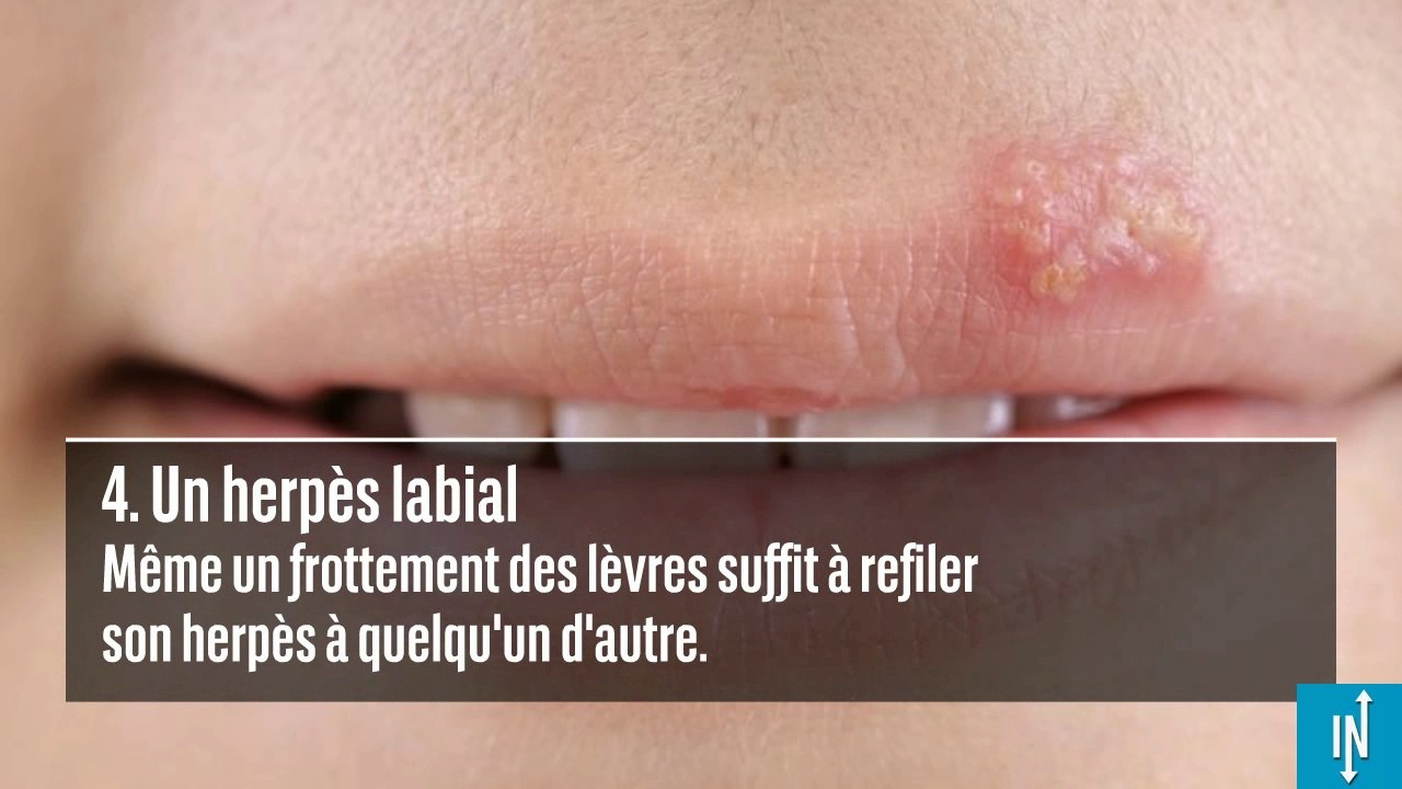 6 maladies que vous pouvez contracter en embrassant quelqu'un