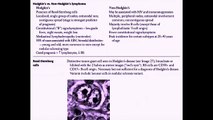 USMLE  - Various Lymphomas (vs Leukemia)