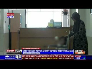 Jari Tangan Balita di Bandung Putus Akibat Bakteri Ganas