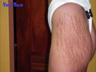 COMO ELIMINAR LAS ESTRÍAS EN 60 DIAS