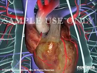Heart Bypass Surgery (CABG)