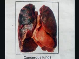 How Smoking Kills You