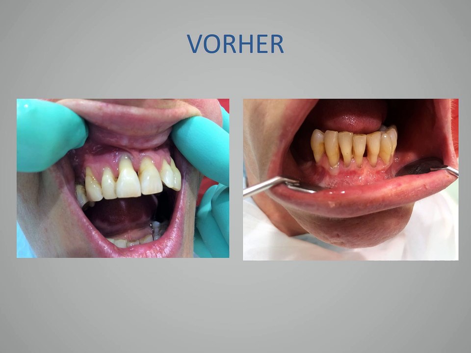 Zahnimplantate Erfahrungen, Zahnklinik Budapest Erfahrung, Zahnarzt Empfehlung