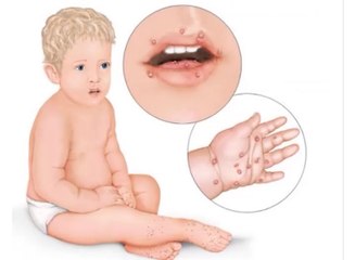 Manje obolelih od bolesti šaka, stopala i usta, 18. avgust 2016 (RTV Bor)