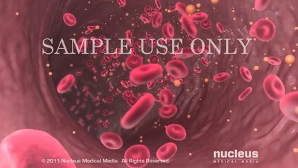 Patient Education Video׃ Low Testosterone