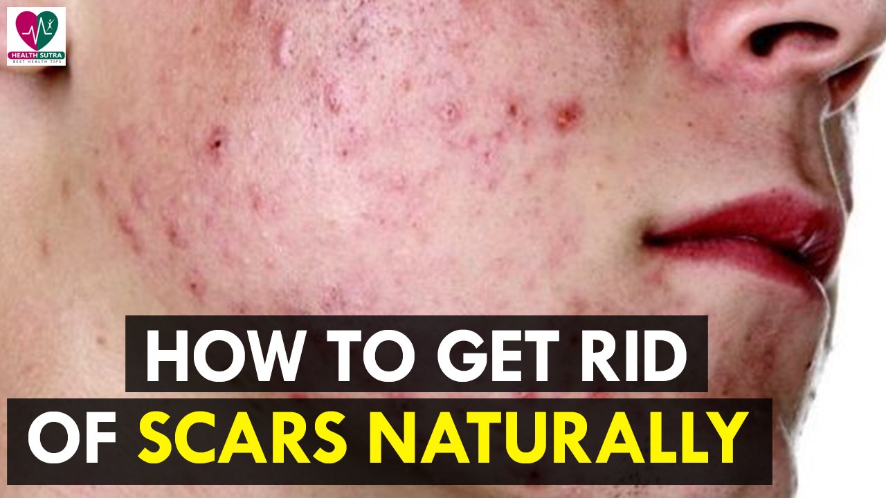 How to Get Rid of Scars Naturally - Health Sutra