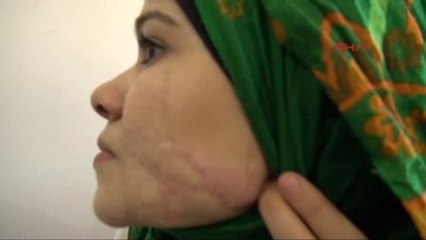 Reyhanlı 52 Kişi Ölürken Yüzünden Yaralanan Suriyeli Zehra Estetik Ameliyat Olmak İstiyor