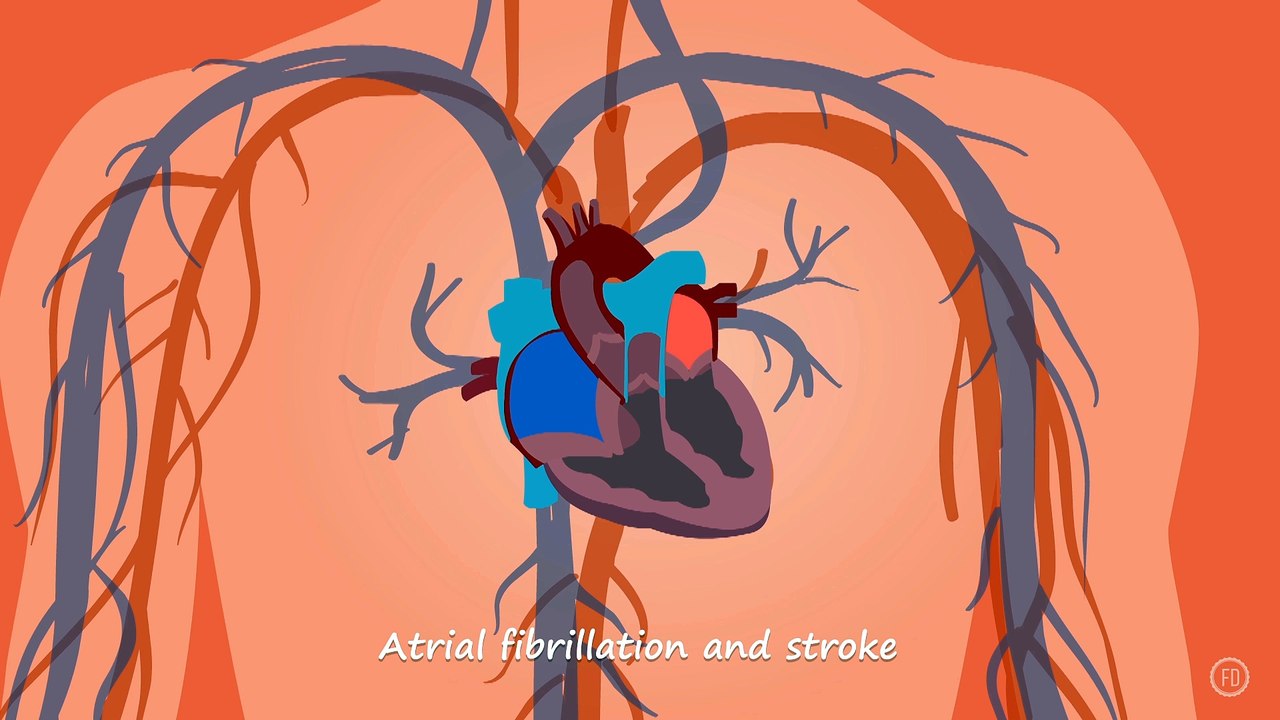 Atrial Fibrillation and Stroke | Medical Education | HD Video | F1 Digitals