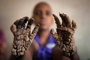 Küçük Çocuk Giderek Ağaca Dönüşüyor