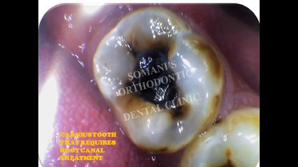 root canal treatments in ahmedabad