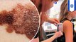 Israeli scientists just made a melanoma skin cancer breakthrough that could lead to a cure