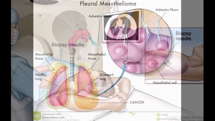 Mesothelioma Survival Rates 2016