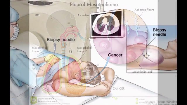 What Is Mesothelioma? - Mesothelioma Survival Rates - Mesothelioma Lawyer