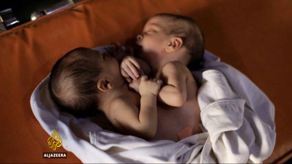 Syrian conjoined twins die awaiting surgery