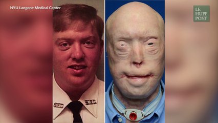 Le pompier qui avait été complètement greffé du visage retrouve une vie normale un an après