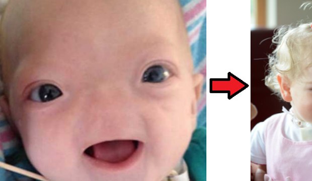 A Baby Born Without a Nose is Grown up and is looking Adorable