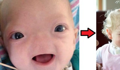 A Baby Born Without a Nose is Grown up and is looking Adorable