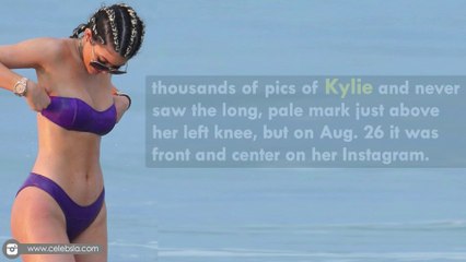Kylie Jenner Flaunts Huge Scary Scar On Her Thigh