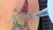 How does tattoo removal laser work-Unwanted Tattoos