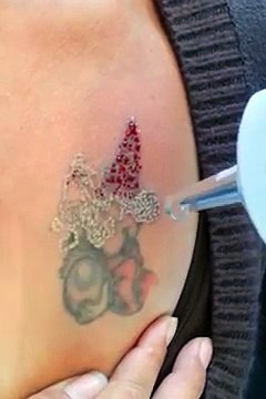 How does tattoo removal laser work-Unwanted Tattoos