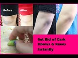 Get Rid of Dark Black Elbows & Knees Super-fast (20 Minutes)