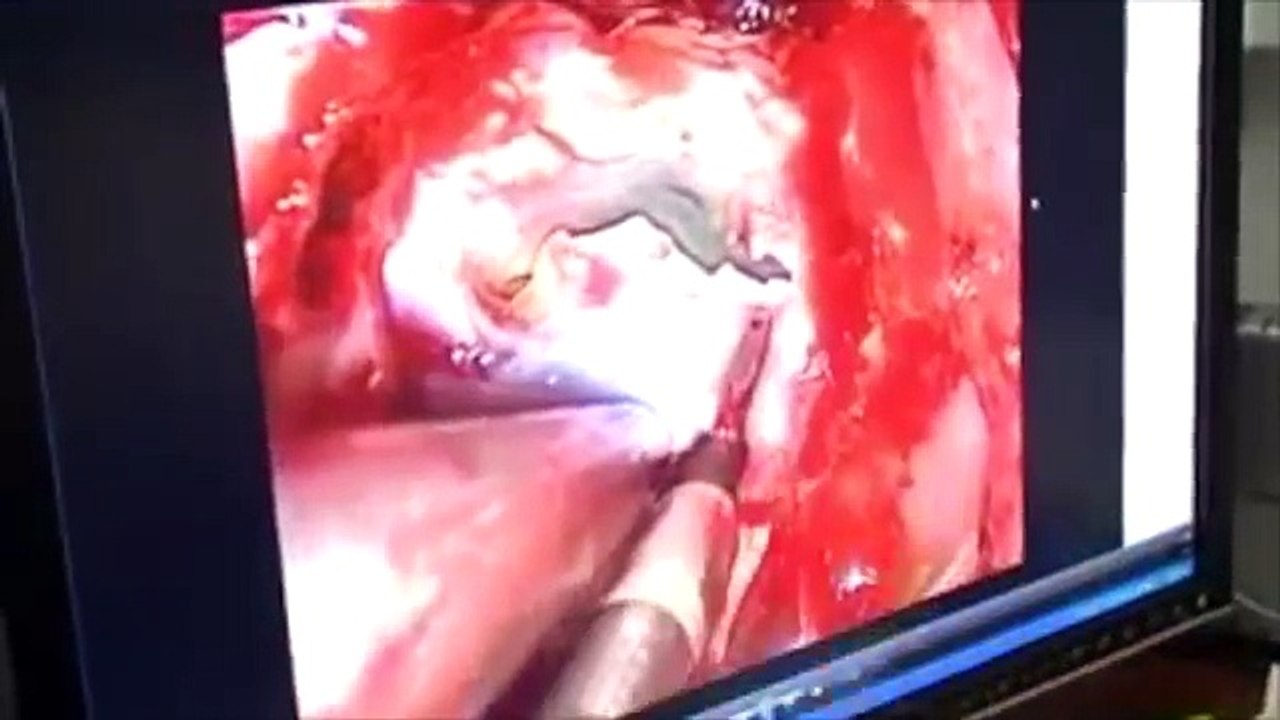 Endoscopic Skull base Neurosurgery [Weill Cornell]